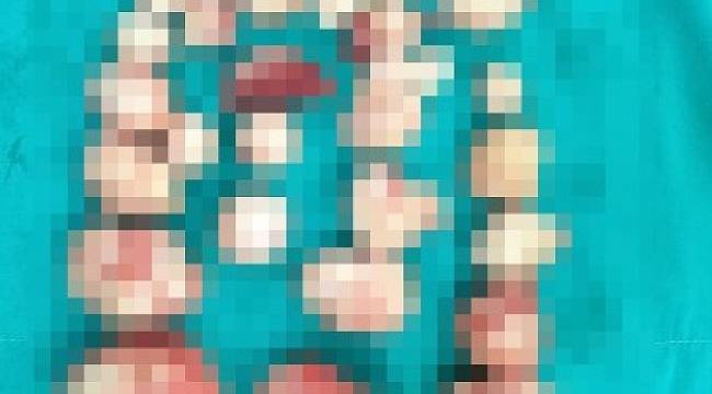 Hastanın rahminde 72 miyom çıkarıldı