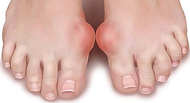 Gut hastalığı nedir? Nasıl tedavi edilir?